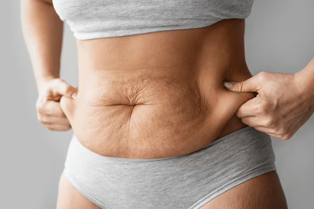 O que é a Abdominoplastia Pós-Bariátrica?