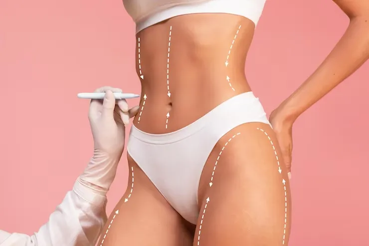 Lipoaspiração e Abdominoplastia