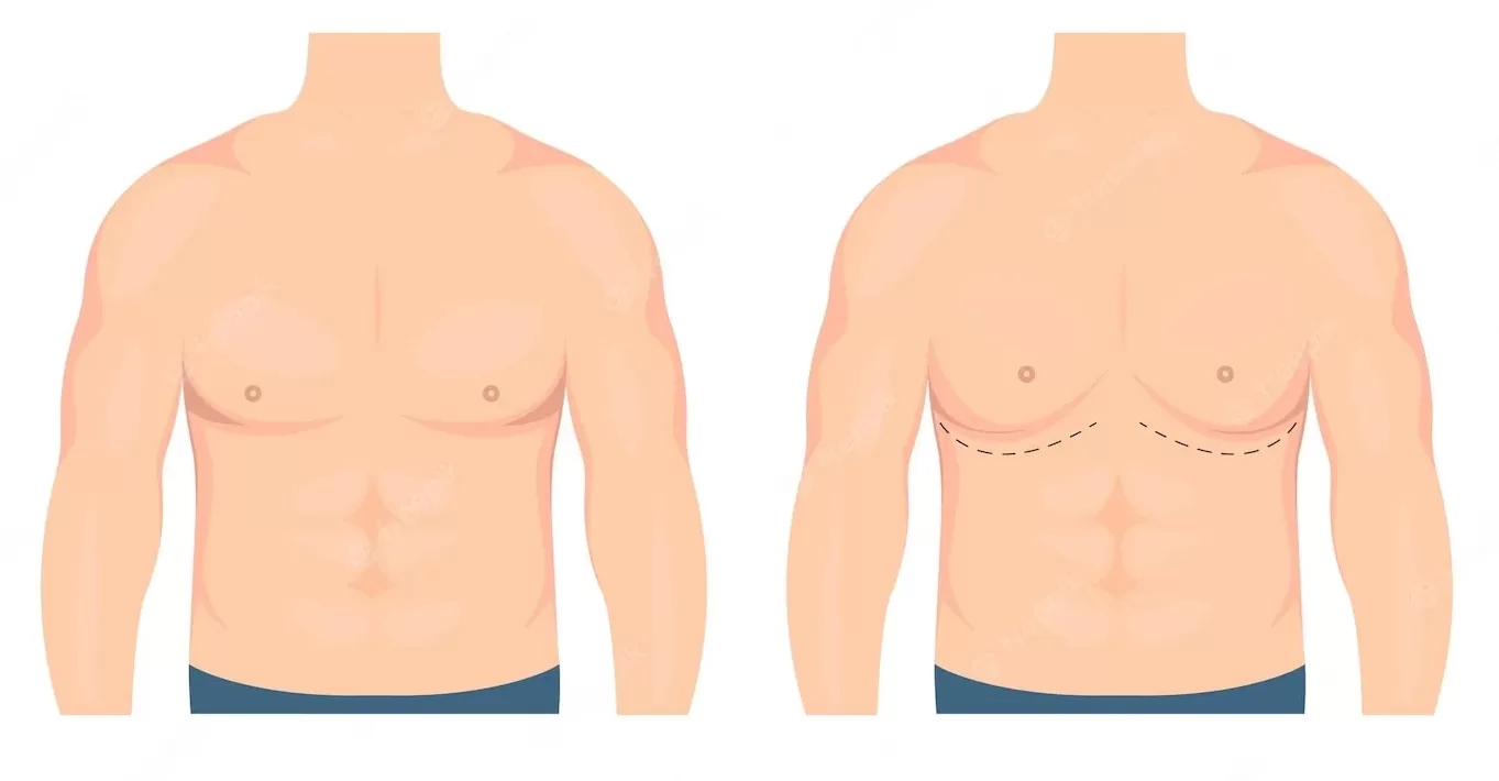 Cuidados pré-operatórios da cirurgia de Ginecomastia