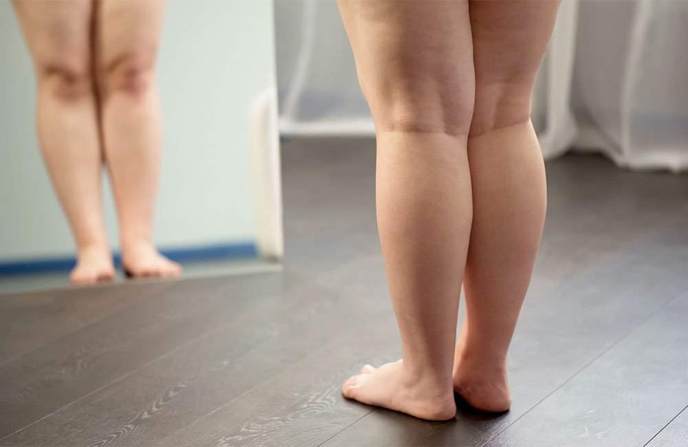 Lipedema: Gordura nas coxas e quadris