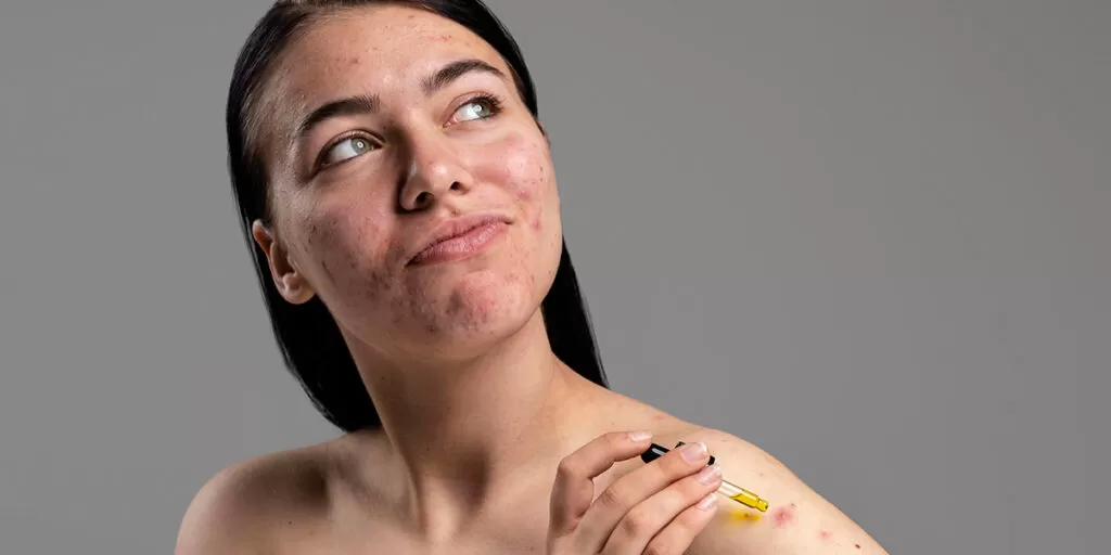 Saiba tudo sobre Cicatriz de Acne