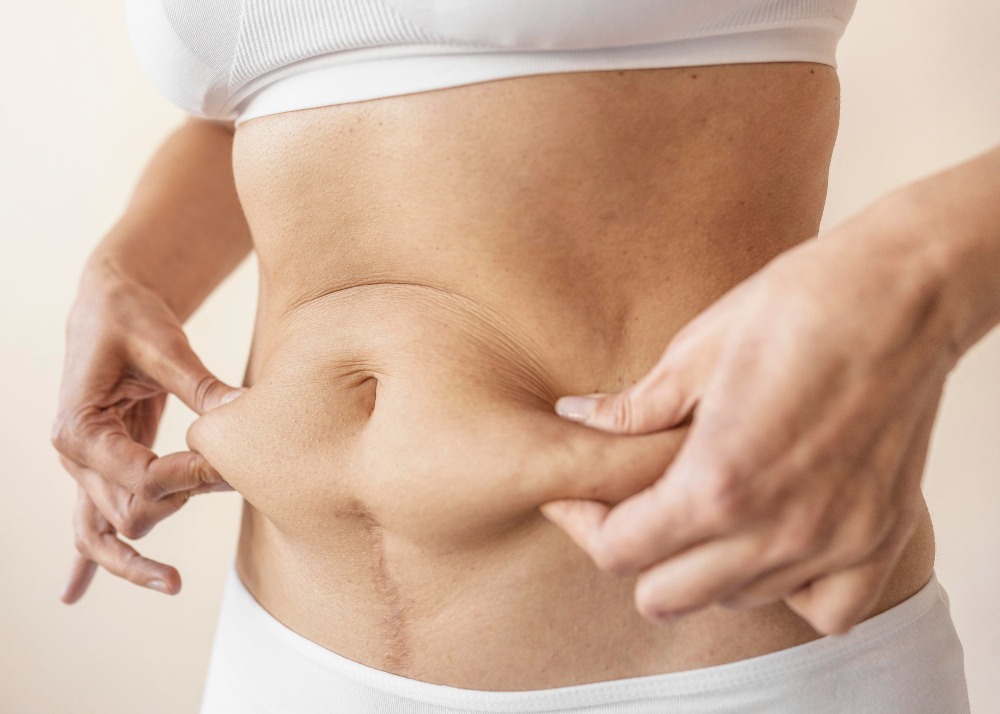 Abdominoplastia pode ser associada com outras cirurgias? - Dr. Vitor Nunes