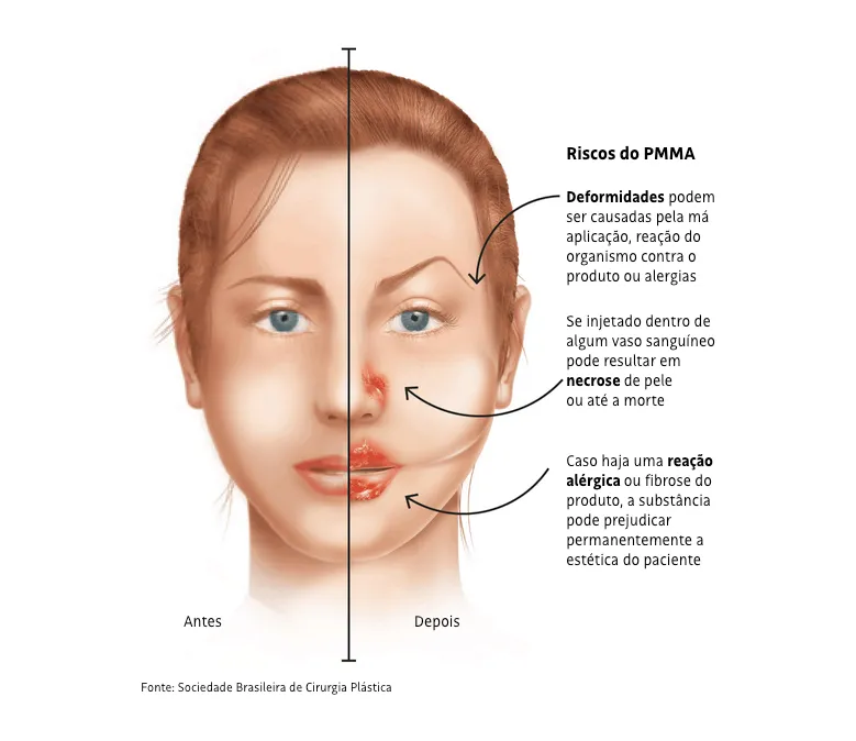 Riscos e complicações da aplicação de PMMA