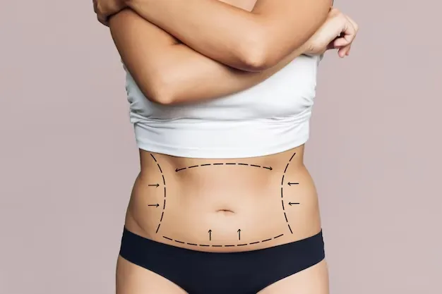 O que é a Abdominoplastia Estendida?